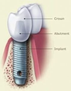 Dental Implants London 