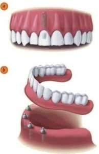 Dental Implants Sarnia 