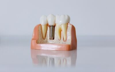 6 Ways Dental Implants Lead to Highest Quality of Life